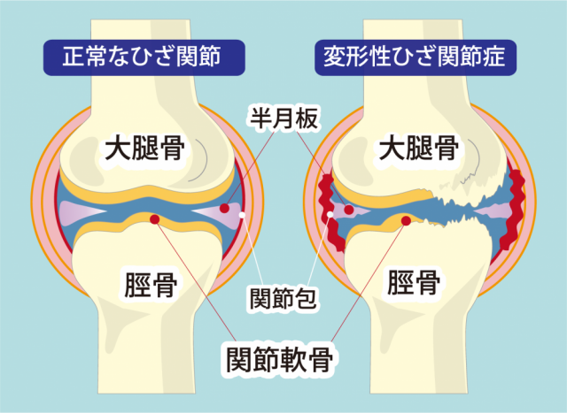 変形性膝関節症| 新小岩の整体【まつなが鍼灸整骨院】