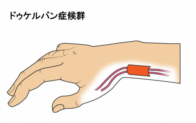 腱と腱鞘イラスト